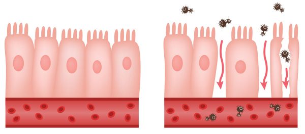 El síndrome del intestino permeable